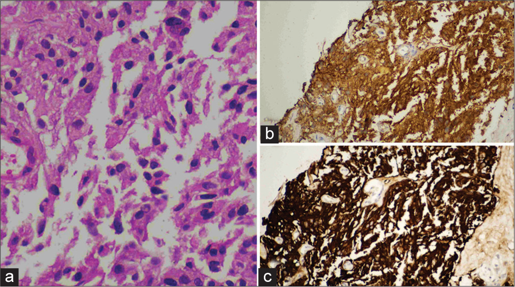 (a) Histopathology image shows a nests and loose clusters of relatively monomorphous epithelial cells exhibiting ill-defined cell borders, moderate granular eosinophilic cytoplasm, and ovoid nuclei with coarse chromatin and inconspicuous nucleoli. These cell clusters are separated by fibrous septa. There is no necrosis. (b and c) Immunohistochemical image shows positive for neuron specific enolase and synaptophysin markers.