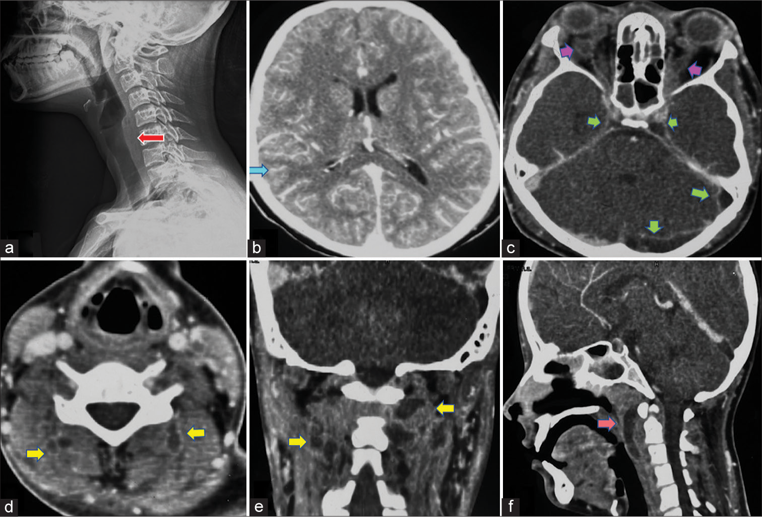 Imaging at initial presentation shows, (a) lateral projection of neck radiograph showing increased prevertebral soft-tissue thickness (red arrow). (b) Axial section of contrast enhanced computed tomography (CT) scan of head, delayed phase showing sulcogyral enhancement (blue arrow). (c) Axial contrast enhanced computed tomography (CECT) head, venous phase showing filling defect in the left transverse, sigmoid, and bilateral cavernous sinuses (green arrows) suggestive of cerebral venous sinus thrombosis. Also note thrombosis of bilateral superior ophthalmic veins (purple arrows). (d) Axial and (e) coronal sections of contrast CT showing rim enhancing collections in bilateral paravertebral soft tissues (yellow arrows). (f) Sagittal section of contrast CT showing rim enhancing collection in prevertebral soft tissue (pink arrow) suggestive of retropharyngeal abscess. Note the tip of odontoid process is below an imaginary Chamberlain’s line at this stage.