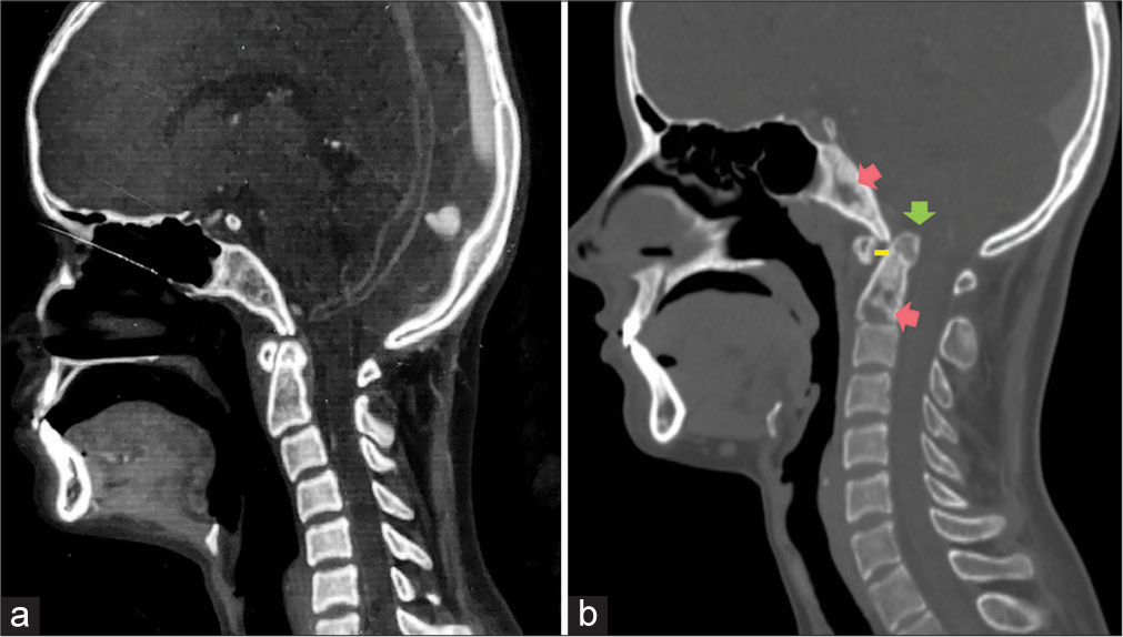 Comparative computed tomography (CT) images sagittal sections of the same patient (a) taken 1 month after diagnosis of retropharyngeal abscesses showing resolution of collections. Note the normal position of the tip of odontoid process and the normal atlanto-axial distance. (b) CT taken 4 months after the aforementioned scan showing lytic permeative erosions in odontoid process and clivus (pink arrows) suggestive of osteomyelitis. The tip of odontoid process is above the imaginary chamberlain’s line and projecting into the foramen magnum (green arrow). Also note the increase in atlanto-axial distance (yellow line) in comparison to (a). These findings are suggestive of basilar impression or acquired basilar invagination secondary to infection of the cervical region.