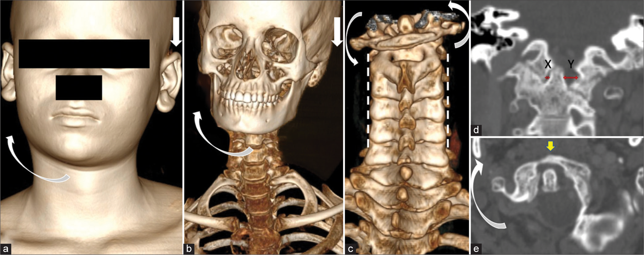 Imaging at later stage shows (a) Shaded surface display of head and neck of the patient showing Cock-Robin position of head (head is tilted towards left side and chin is rotated to the contralateral side, demonstrated by straight and curved white arrows respectively) indicating torticollis. (b) Volume rendered 3 Dimensional CT images showing similar aforementioned findings (head is tilted towards left side and chin is rotated to the contralateral side, demonstrated by straight and curved white arrows respectively) (c) Volume rendered 3 Dimensional CT images from the posterior aspect of spine showing rotation of C1 (Atlas) over C2 (Axis), represented by curved white arrows. (d) Sagittal images of CT scan, bone window showing an asymmetry in the atlas-axis distance with a greater distance between dens and atlas on the left side (Y > X, red arrows denoting X and Y). (e) Axial images of CT scan, bone window showing rotation of atlas (yellow arrow) in relation to the axis, curved white arrow.