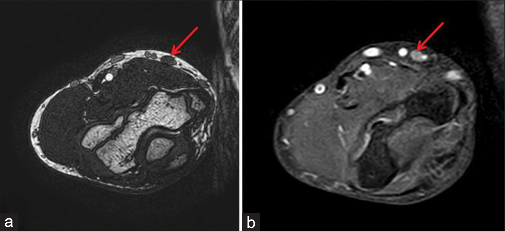 A 14-year-old male with borderline tuberculoid leprosy who presented with painless swelling in the right upper arm and proximal forearm, magnetic resonance imaging axial T2 space images (a) shows thickened medial cutaneous nerve in arm (red arrow), (b) shows enhancement in T1 post-contrast fat-saturated image (red arrow).