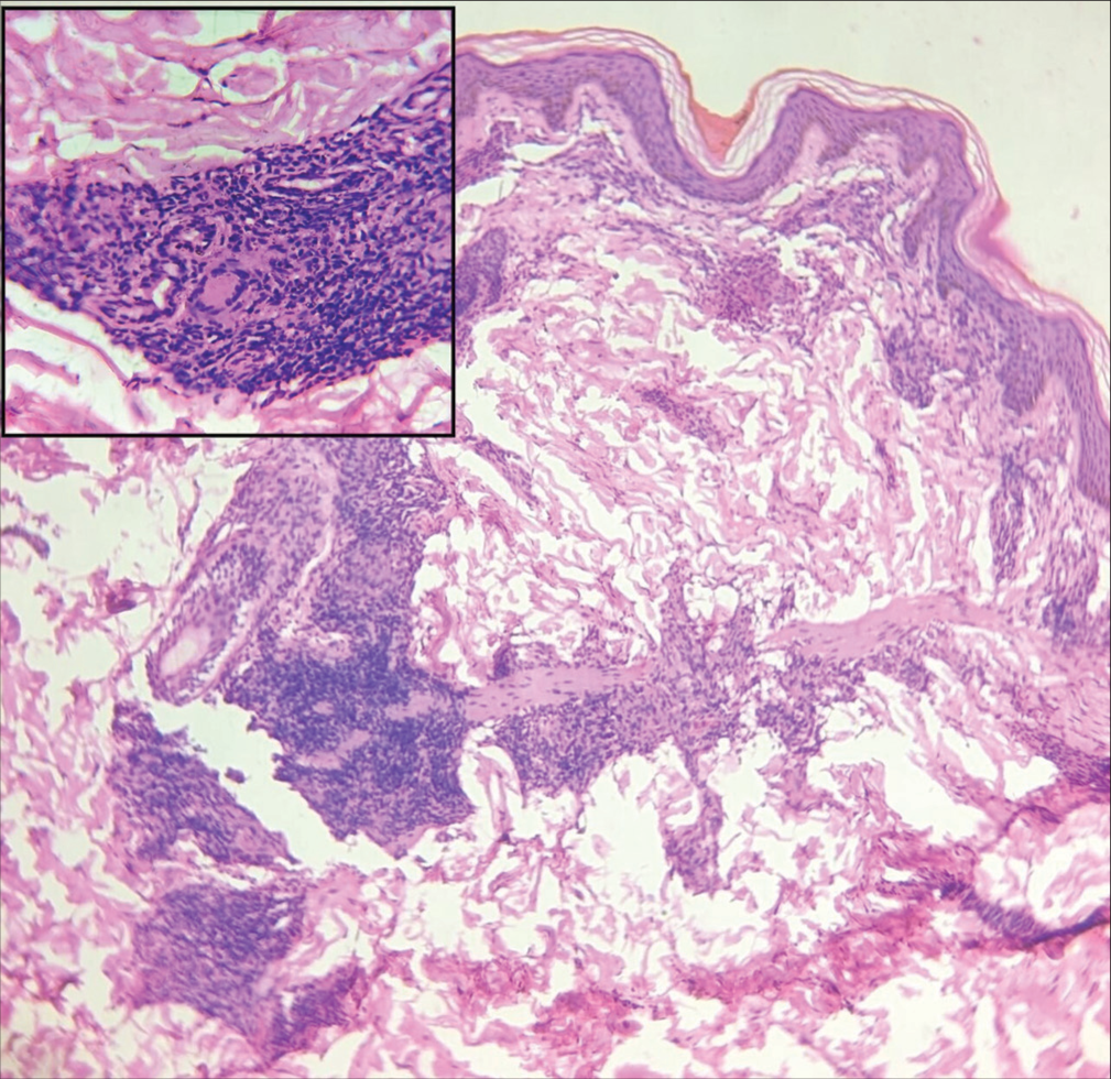 Histopathology image shows normal epidermis and dermis with multiple granulomas, epitheloid cells, and abundant lymphocytes around the nerves. Inset image (right upper corner) shows granuloma with multinucleate giant cell – Features suggestive of borderline tuberculoid leprosy.