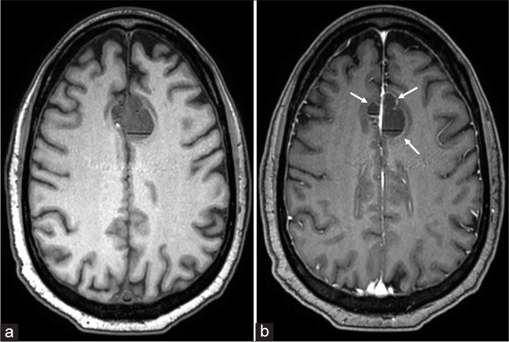 (a) Pre-contrast and (b) post-contrast axial T1-weighted images demonstrating subtle rim enhancement (white arrows) of the cystic lesions.