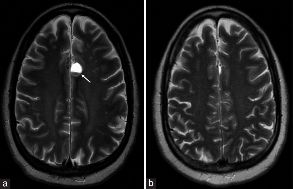 (a) T2-weighted image acquired after 3 months of treatment showing the anterior parafalcine lesions containing hemorrhagic products measuring up to 2.1 x 1.1 cm predominantly along the left parafalcine region (white arrow). The previously seen smaller right parafalcine hemorrhagic lesion is almost completely resolved. (b) T2-weighted image acquired 3 months after Fractionated stereotactic radiation therapy (FSRT) to the cranial lesions showing complete interval resolution of previously seen layering cystic lesions.