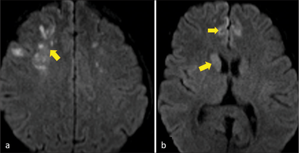 Magnetic resonance imaging - Diffusion-weighted scans reveal multiple acute infarcts in (a) the frontal lobes and (b) right basal ganglia involving the anterior circulation of bilateral cerebral hemispheres (yellow arrows).