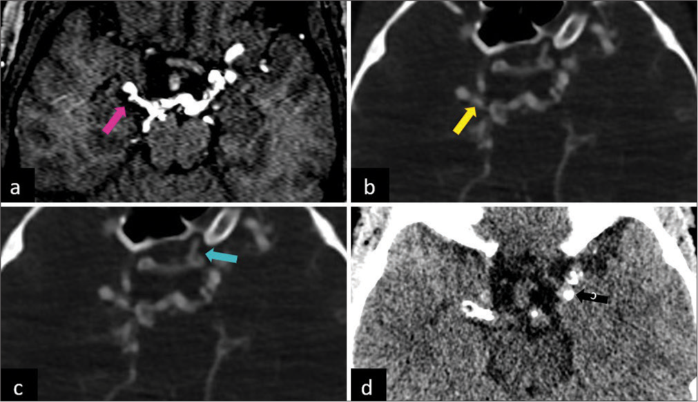 (a) Magnetic resonance angiogram reveals an aneurysm arising from the right posterior communicating artery (magenta arrow). (b and c) Computed tomography (CT) angiogram study reveals the right posterior communicating artery reforming the right middle cerebral artery and anterior cerebral artery (yellow arrow) and a branch from the left external carotid artery reforming the cavernous segment of the left internal carotid artery (cyan arrow). (d) CT non-contrast study shows extensive calcifications along the compensatory circulation developed from the posterior circulation and the left external carotid artery (black arrow).