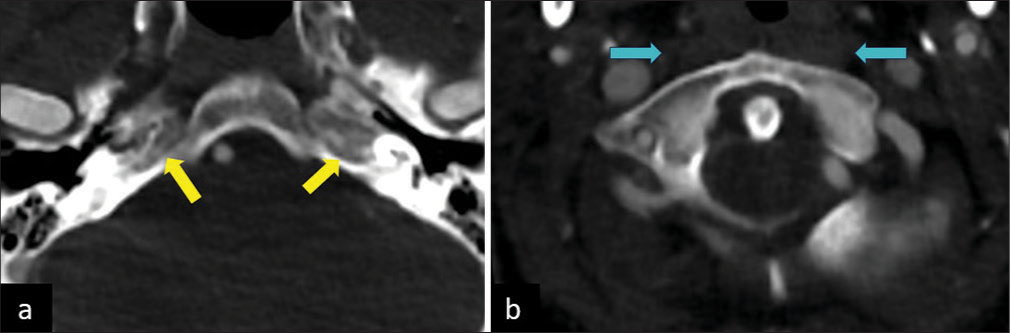 (a) Axial computed tomography (CT) sections in the bone window reveal the absence of bilateral carotid canals (yellow arrows). (b) CT angiogram study reveals the absence of bilateral internal carotid arteries (ICAs) (cyan arrows indicate the expected location of ICAs).