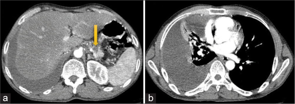 (a) Contrast-enhanced computed tomography showing pseudocyst (yellow arrow) in the body of the pancreas. (b) Gross right pleural effusion.