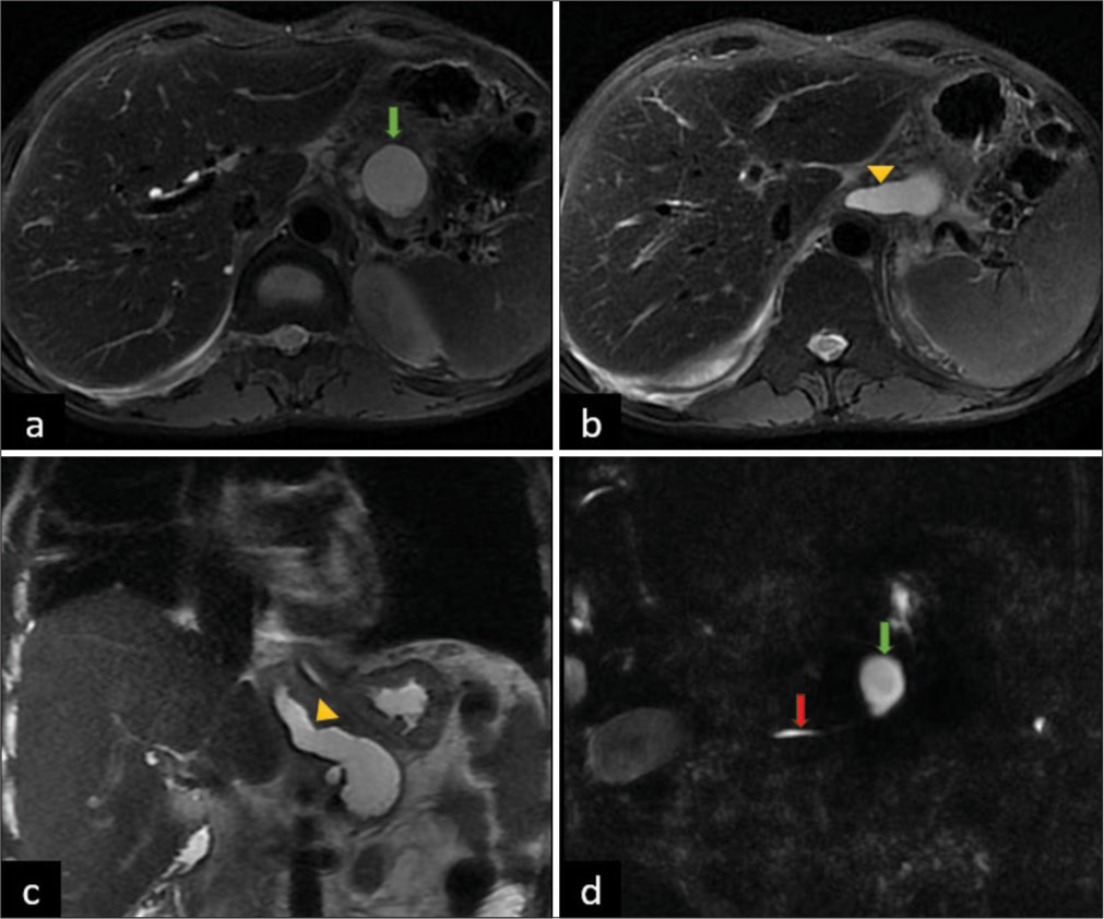 (a) Axial T2 MRI showing pseudocyst in pancreatic body (green arrow). (b) Linear non ramifying fistulous tract (yellow arrowhead). (c) Coronal T2 MRI showing fistula (yellow arrowhead) extending into right pleural cavity. (d) Magnetic resonance cholangiopancreatography (MRCP) image showing communication of pseudocyt (green arrow) with main pancreatic duct (red arrow).