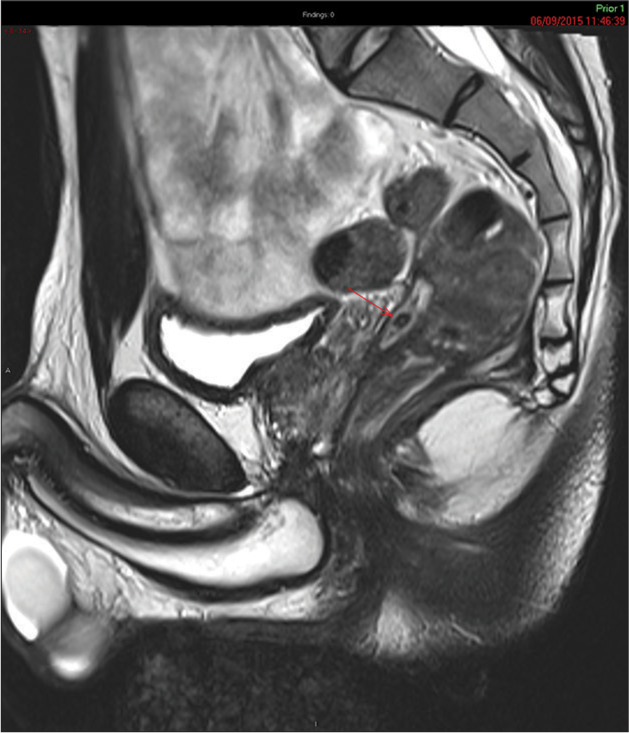 Sagittal plane T2-weighted pelvic magnetic resonance imaging showing signal void of appendicolith (red arrow) in a high T2 signal fluid tract in the pouch of Douglas.