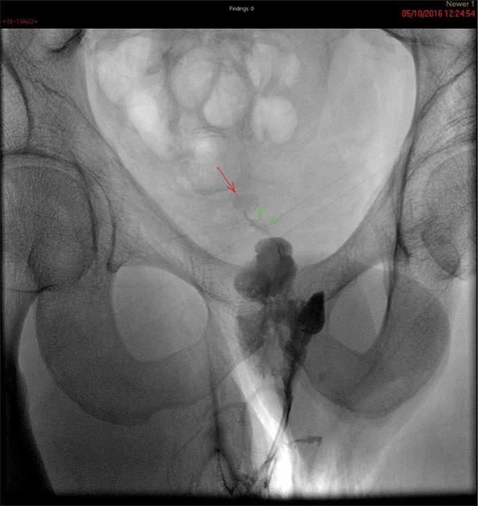 Water soluble contrast fistulogram performed through perineal catheter outlining an irregular extrasphincteric tract and cavity with small fistula (green arrow heads) leading to calcified dropped appendicolith (red arrow) in the pouch of Douglas which was the source of the infection.