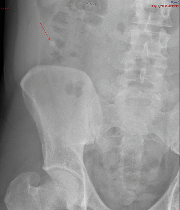 AXR performed at presentation of appendicitis showing a calcified appendicolith (red arrow) in the right iliac fossa. AXR: Abdominal X Ray.