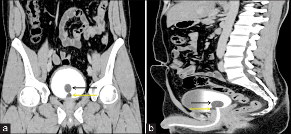 (a) Coronal and (b) Sagittal CT urography images reveal a small Brunn’s cyst located in the midline anterior to the bladder neck, as indicated by the arrows (black arrows- Folley’s Bulb and yellow arrows- Brunn’s cyst). CT: Computed tomography.