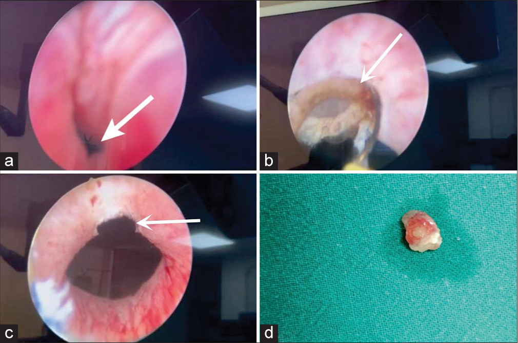 (a and b) Cystoscopic images illustrate Brunn’s cyst, marked with arrows from various angles. (c) After cystoscopic resection, as indicated by the white arrow, the (d) resected specimen of Brunn’s cyst is shown. The postoperative image reveals the cyst that has been resected through cystoscopy and transurethral resection.