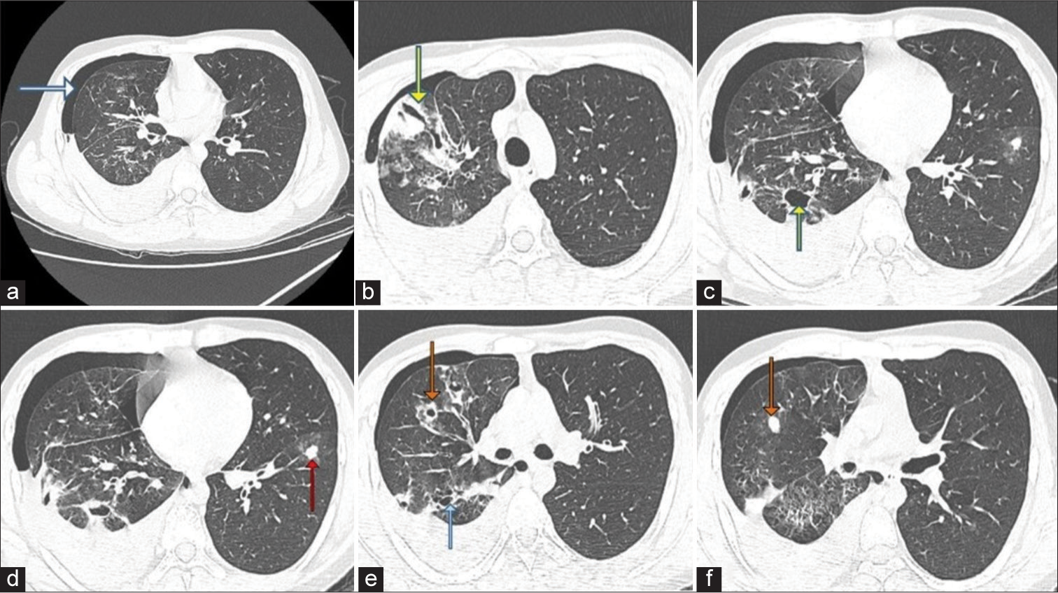 A 20-year-old male presented with recurrent hemoptysis, recurrent knee joint dislocations and easy bruisability of skin. Axial high-resolution computed tomography chest images taken on April 10, 2023, show (a) recurrence of hemopneumothorax (white arrow). When compared to the scan of February, the extent of pneumothorax has decreased, (b) the previously mentioned thick-walled cavity (yellow arrow) in the apical segment of the right upper lobe had collapsed to a slit-like shape. (c) A couple of the previously seen cavities (yellow arrow) in the posterior segment of the right upper lobe are better seen due to the expansion of the lung and reduction of pneumothorax. (d) Multiple well-defined, branching soft-issue density nodules (red arrow) like lesions were noted involving bilateral lung fields. Some of these nodules are surrounded by ground-glass attenuation. These lesions were not seen in the previous scan. (e) Some of the nodules show evidence of cavitation (orange arrow). Few thin-walled, cystic lesions (blue arrow) in the right lung, predominantly in the lower lobe, (f) soft tissue density nodule (orange arrow).