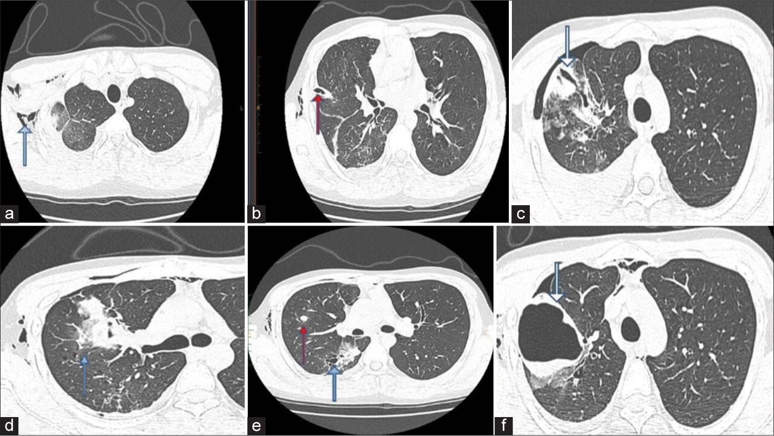 A 20-year-old male presented with recurrent hemoptysis, recurrent knee joint dislocations and easy bruisability of skin. Axial high-resolution computed tomography chest images taken on 18/04/2023 show (a) Surgical emphysema (blue arrow) noted involving the anterior and lateral walls of the right side of the chest as well as soft tissues of the neck, (b) Interval insertion of right Intercostal drainage tube (red arrow) noted with the tip in the upper aspect of oblique fissure. (c) Showing slit-like cavity (white arrow) in the study done on 10/04/2023, however the images taken on 18/04/2023. (d) There is significant resolution in the ground glass opacities (blue arrow) bilaterally (e) Previously noted nodules (red arrow) in bilateral lung fields appear stable in size and number. Thin-walled cystic lesion (blue arrow) in the right lung persists, (f) show a re-expansion of borderline thick-walled cystic lesion (white arrow) in the apical segment of the right upper lobe, with dependent hyperdense fluid within. Pneumohemothorax has comparatively reduced.