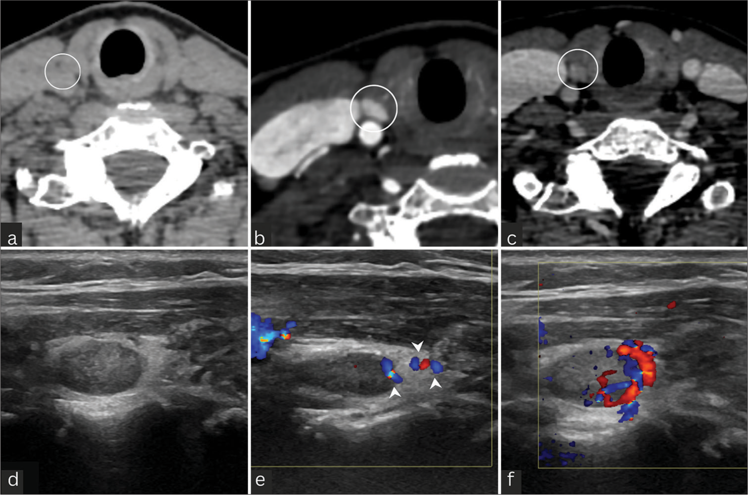 Axial four-dimensional computed tomography images (a-c) revealed a Type A parathyroid adenoma (circles) which demonstrates (a) hypodense arterial phase (b) hyper-enhancing lesion, which is (c) iso-enhancing in the venous phase. (d) USG Neck Grey scale showing a well defined ovoid iso-mildly hypoechoic nodule. Color and power Doppler images showing internal vascularity in predominant peripheral distribution. (e) The feeding artery (white arrowheads) tends to branch around the periphery of the gland giving the (f) characteristic arc rim of vascularity. Peripheral extrathyroidal feeding arteries seen suggesting a parathyroid lesion over a primary thyroid nodule. USG: Ultrasonography.