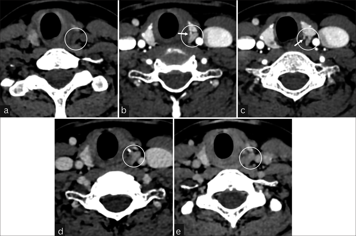 Four-dimensional computed tomography study shows a parathyroid lesion with type B enhancement characteristics. (a) Non-enhanced phase axial image shows an oval lesion (circle) posterior to the upper pole of the left thyroid lobe and medial to the left common carotid artery. The mass has low attenuation. (b and c) The arterial phase axial image reveals the lesion (circles) is vividly enhancing (however, less than the adjacent thyroid gland) and a polar vessel (arrows) leading to a parathyroid adenoma. (d and e) Venous and delayed phase axial images show washout of contrast material with decreasing attenuation (circles) compared with the arterial phase.