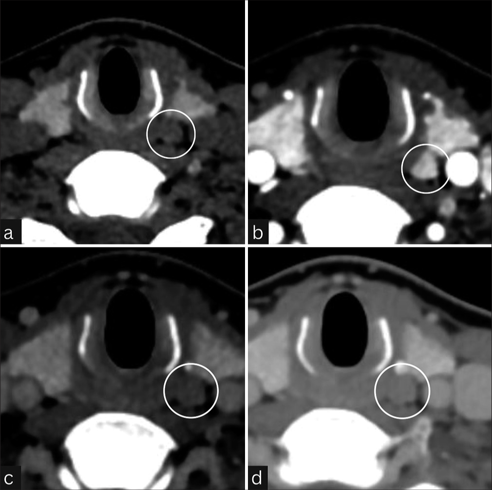 Parathyroid adenoma on Four-dimensional computed tomography in a 32-year-old female with hypercalcemia: (a) small, well-defined ovoid hypodense lesion (circle) posteromedial to the left lobe of the thyroid gland. (b-d) Axial arterial phase images of lesion showing (b) iso-mild hypoenhancement with (c) washout in subsequent venous and (d) delayed phases (depicted in circles on each image).