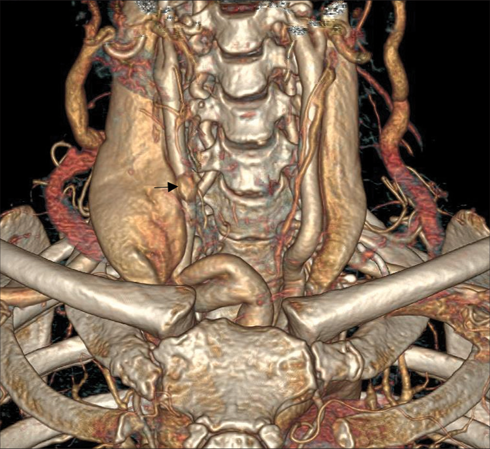 Coronal reformatted image in the arterial phase demonstrating oval lesion (black arrow) that is separate from the thyroid gland, medial to the right internal jugular vein consistent with type A parathyroid adenoma described in case 2.