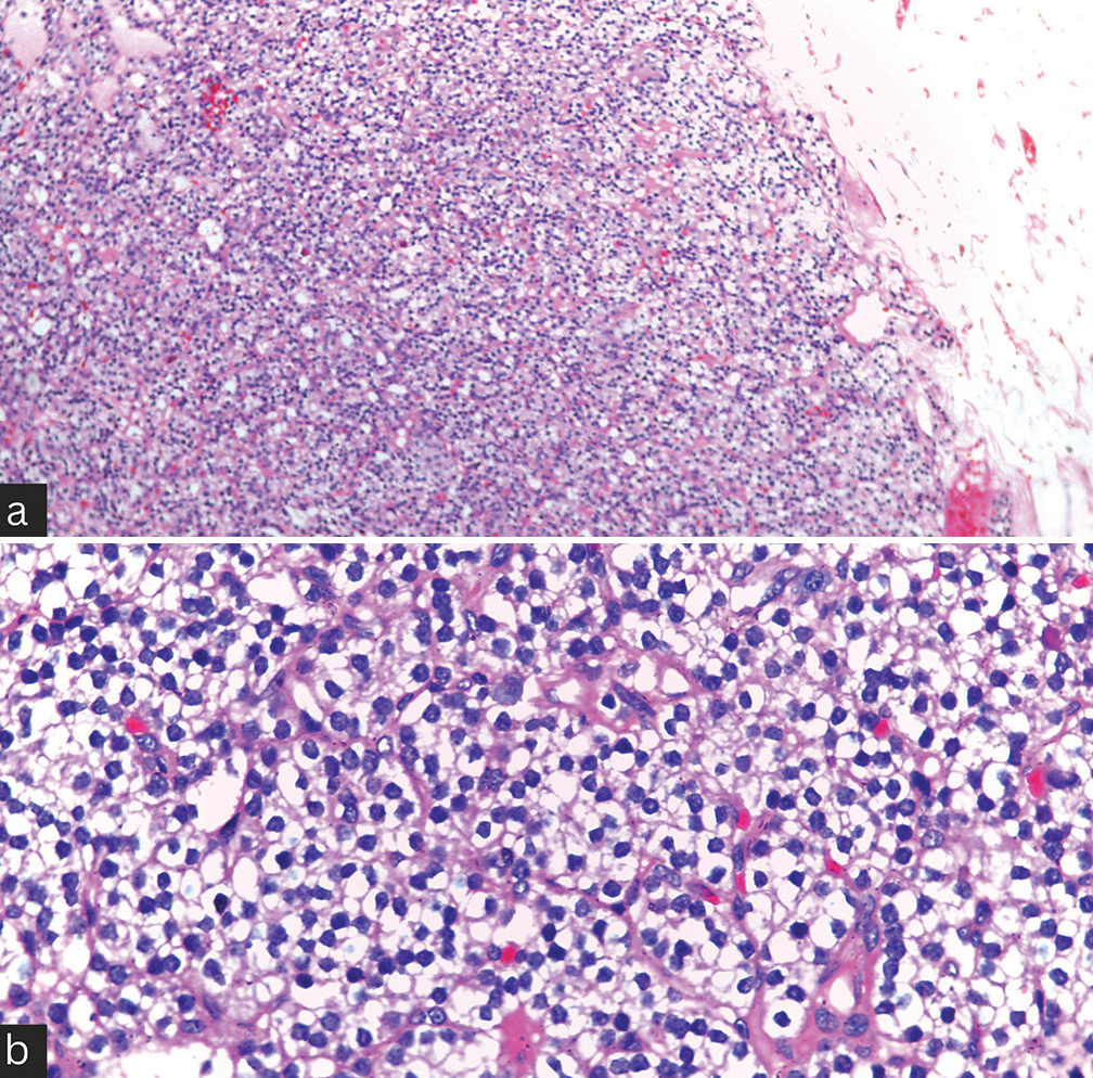 Histopathology images of the surgically excised parathyroid adenoma specimen (a) Low power field and (b) High power field images showing fairly encapsulated neoplasm of cells arranged in lobules and nests separated by thin fibrovascular septa. Individual neoplastic cells are polygonal with moderate clear to pale eosinophilic cytoplasm, round centrally placed nuclei showing fine dispersed chromatin. Few cells with moderate eosinophilic cytoplasm and round-to-oval hyperchromatic nuclei (oxyphil cells) were noted in between the neoplastic cells.