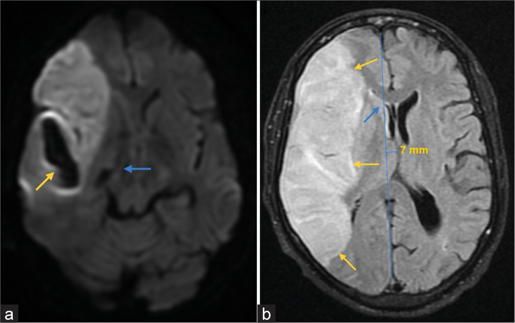 (a) MRI Brain susceptibility weighted imaging (SWI) sequence showing an area of blooming involving the region of the right temporal infarction (yellow arrow), suggestive of the hemorrhagic changes within. (b) MRI Brain fluid-attenuated inversion recovery (FLAIR) sequence showing hyperintensities in right frontoparietal region (yellow arrows) with mass effect in the form of effacement of ipsilateral sulci and lateral ventricle (blue arrow). There is also mild distortion of the ipsilateral side of mid brain (blue arrow in a) and a midline shift of 7 mm towards left.