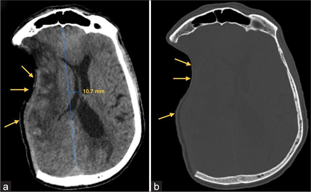 (a) CT Brain axial section reveals ill-defined hypodensities involving right frontoparietal region consistent with large right middle cerebral artery (MCA) territory infarct with mass effect in form of effacement of the ipsilateral sulci (yellow arrows) and lateral ventricle and paradoxical midline shift of 10.7 mm away from the craniectomy site. (b) CT Brain bone window image shows right frontoparietal craniectomy defect with overlying indrawing of the skin flap (yellow arrows).