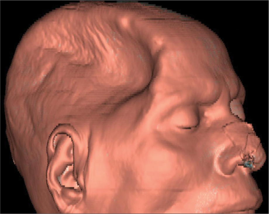 3D CT reconstruction showing a sunken skin flap over the craniectomy site in the right frontoparietal area.