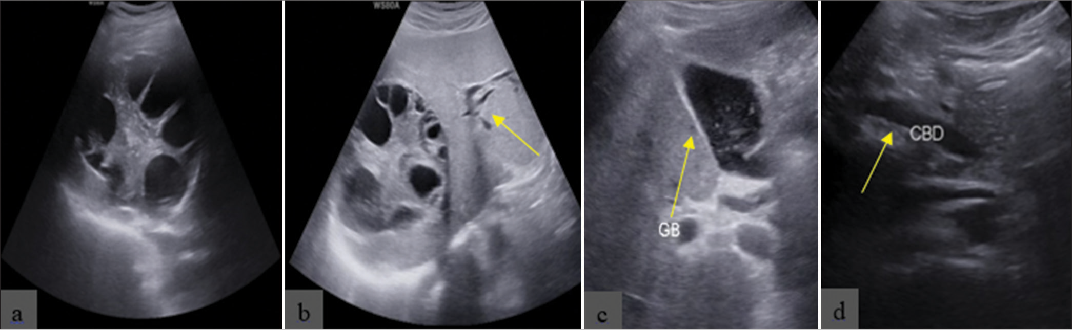 Ultrasound shows (a) hepatic hydatid cyst with multiple daughter cysts involving the right lobe of the liver predominantly in segment 8, (b) mild intrahepatic biliary radicle dilatation (yellow arrow), (c) gallbladder (GB) with sludge-like material with hyperechoic foci (yellow arrow), and (d) common bile duct dilation (CBD) (yellow arrow) measures 10 mm.