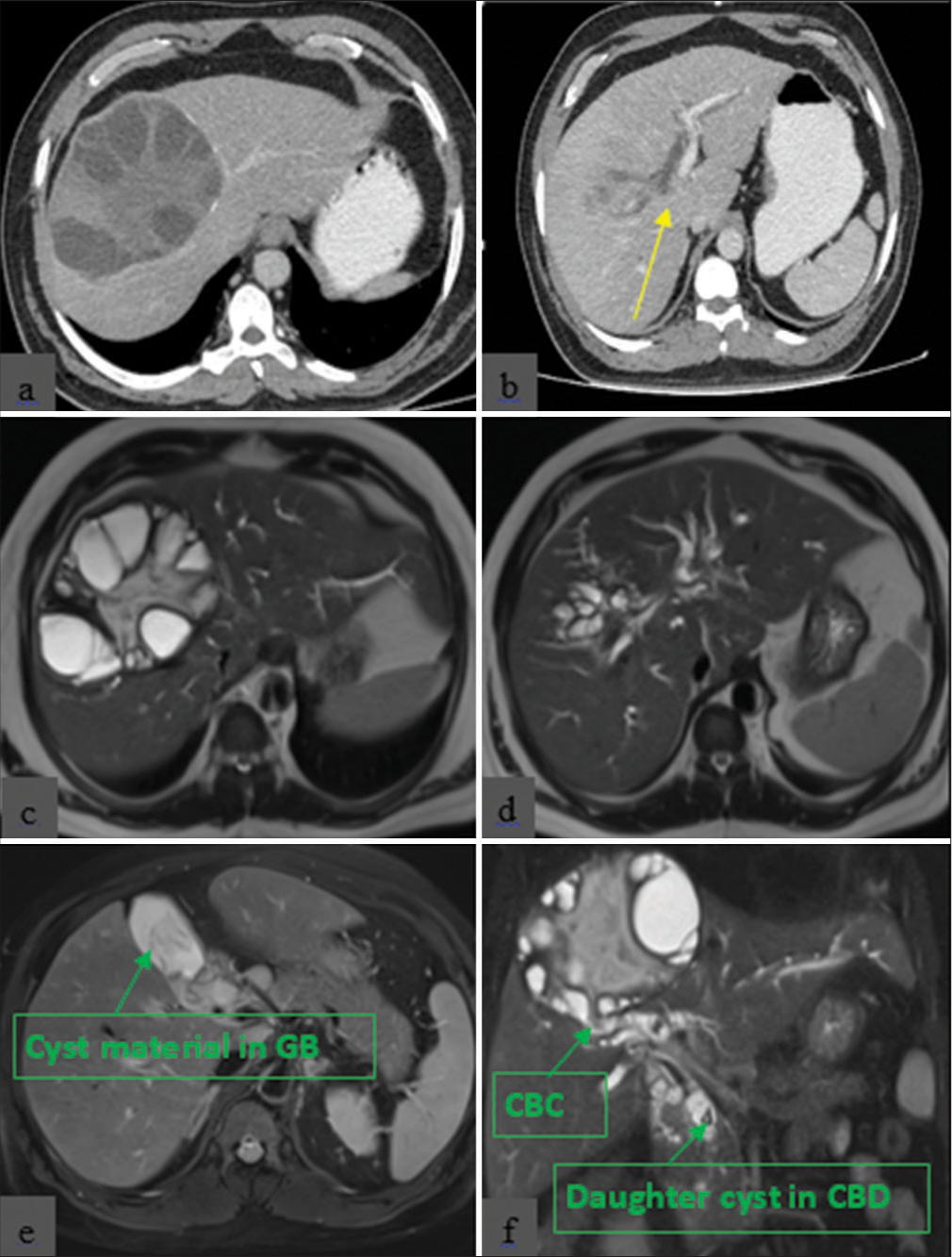 Contrast-enhanced computed tomography shows (a) hepatic hydatid cyst with multiple daughter cysts, (b) intrahepatic biliary radicle (IHBR) dilatation (yellow arrow) and (c) magnetic resonance cholangiopancreatography shows hepatic hydatid cyst with multiple daughter cysts with (d) IHBR dilatation and (e) distended gallbladder (GB) with daughter cyst material within the GB and (f) cystobiliary communication (CBC) with daughter cysts in the common bile duct (CBD).