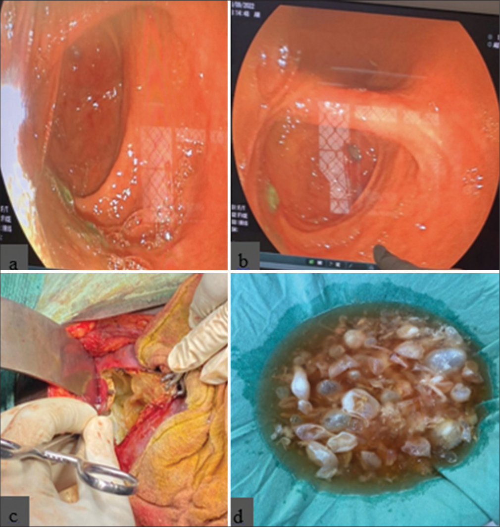 Endoscopic retrograde cholangiopancreatography shows (a and b) daughter cysts in the second part of the duodenum and (c) deroofing, evacuation of cyst content, and (d) removed hydatid cyst during surgery.