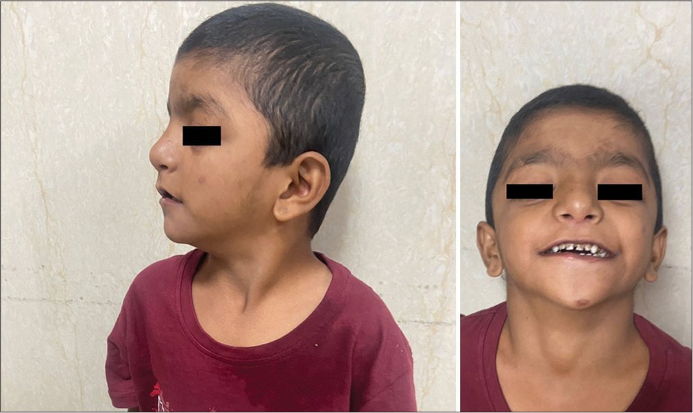 (a) Profile clinical image shows low-set ears and flat occiput. (b) Frontal clinical image shows hypertelorism, widely-spaced teeth, bulbous nose, flattened philtrum, and thin lips.