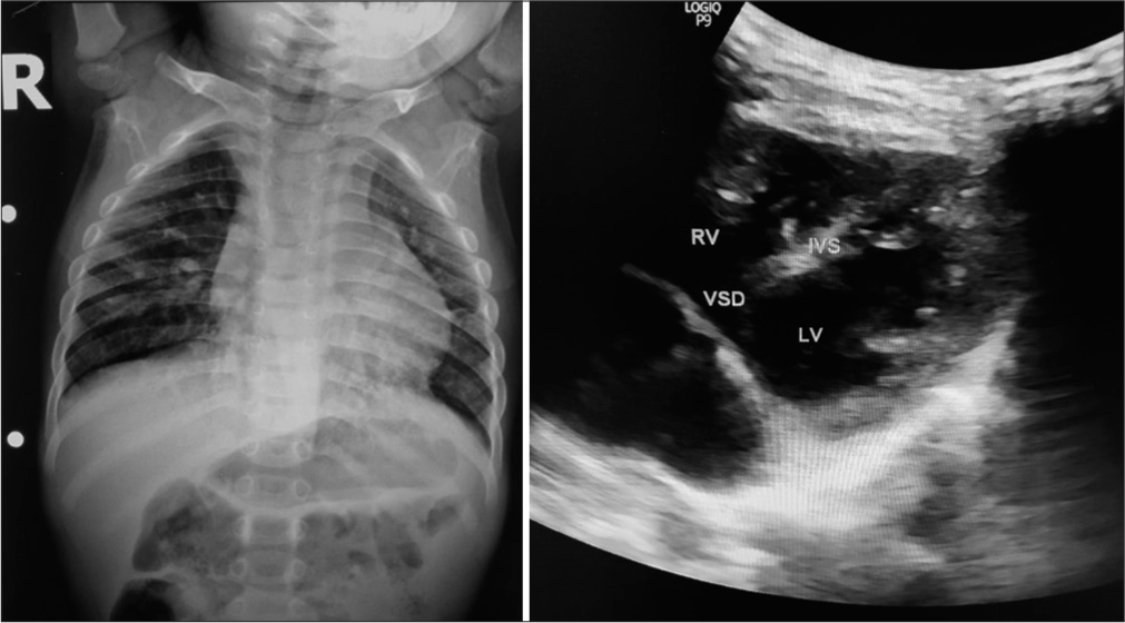 Frontal chest radiograph shows cardiomegaly with upturned apex and pulmonary plethora suggestive of congenital heart disease. 2D ultrasound image using curvilinear probe at 9 Hz in left 5th intercostal space in a four-vessel view shows the high ventricular septal defect. RV = Right Ventricle; LV = Left Ventricle; VSD = Ventricular Septal Defect; IVS = Inter Ventricular Septum.