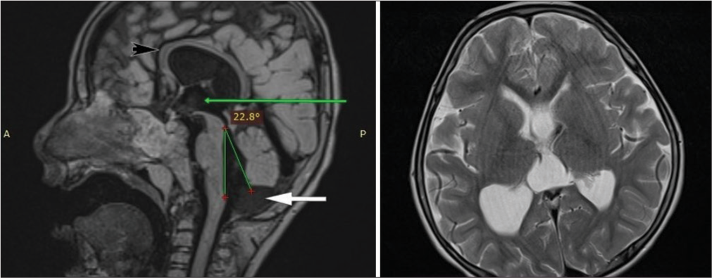 T1 Magnetization-Prepared Rapid Acquisition Gradient Echo (MPRAGE) mid-sagittal image showing inferior vermian hypoplasia (white arrow), with tegmento-vermian angle of 22°, dilated third ventricle (green arrow) and thinned-out corpus callosum throughout its substance (black arrow) with upward bowing. T2 axial image showing dilatation of bilateral occipital horns of lateral ventricles suggestive of colpocephaly.