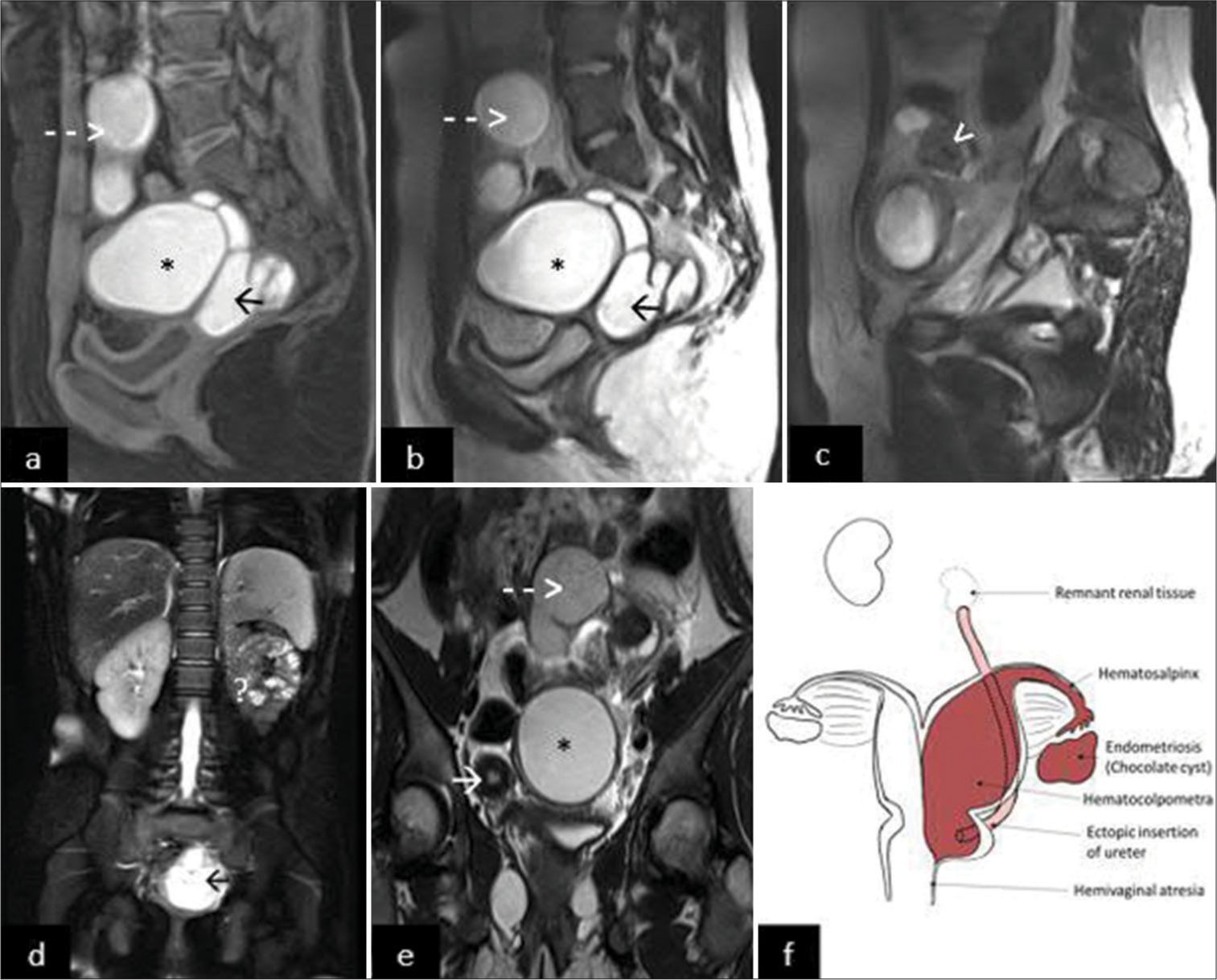 An 11-year-old girl presented with pain in lower abdomen since the onset of menarche 8 months back. (a) T1-weighted sagittal images showing hematocolpometra (*), hematosalpinx (dashed arrow), and hematomegaureter in pouch of Douglas (black arrow); (b) T2-weighted (T2w) sagittal images showing hematocolpometra (*), hematosalpinx (dashed arrow), and hematomegaureter in pouch of Douglas (black arrow); (c) T2w sagittal images showing chocolate cyst (white arrowhead) with peripherally arranged follicles; (d) T2 fat-saturated images showing empty left renal fossa (?) with dilated hematomegaureter in the pelvis (black arrow); (e) T2w coronal images showing uterus didelphys with normal right horn (white arrow) with hematocolpometra (*) and hematosalpinx (dashed arrow); (f) A simplified diagram showing didelphys uterus with left hematocolpometra, hematosalpinx, and endometriotic chocolate cyst in the left adnexa. Left blind hematomegaureter with distal insertion into the cervix. Obstructed hemi vagina with transverse septum. The left kidney is not identified in the renal fossa, with atrophic remnant renal tissue at the blind end of the ureter in the left hemipelvis. The right horn of the uterus, right cervix, and right ovary is normal. Normal morphology solitary right kidney was noted.