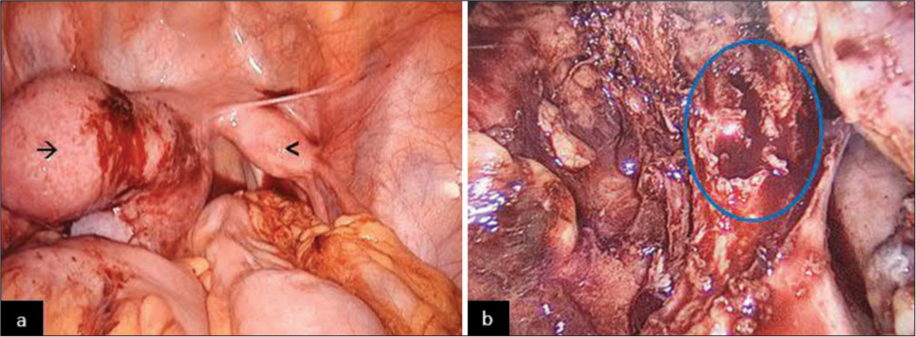 An 11-year-old girl presented with pain in lower abdomen since the onset of menarche 8 months back. Diagnostic laproscopy revealed (a) two uterine horns with normal right uterine horn (arrow head). The left uterus was distended consistent with hematometrocolpos (arrow). (b) After the removal of cervix and uterine horn, a cut megaureter (blue outlined) was seen with chocolate fluid oozing from within.