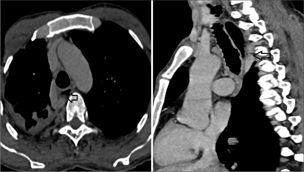 (a) Computed tomography (CT) pulmonary angiography (axial view) showed a dilated azygos vein with the largest diameter of 13 mm, which causes extrinsic compression to the posterolateral aspect of the mid-esophageal region (black arrow). (b) CT pulmonary angiography (black arrow).