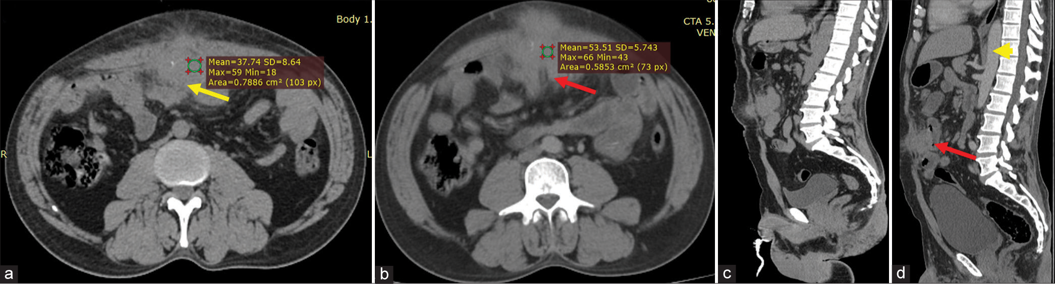 (a) Non-contrast computed tomography (NCCT) shows a irregular hypodense soft tissue lesion (yellow arrow) in the midline anterior abdominal wall just above the umbilicus. (b and c) There is minimal enhancement (red arrow) in post contrast imaging in axial and sagittal planes. No regional lymphadenopathy / free fluid in the abdominal cavity. (d) The lesion abuts the jejunal loop with mild thickening (red arrow), however, no obstruction changes were noted. Note the aorta which appears mildly hyperdense due to contrast opacification (yellow arrow head).