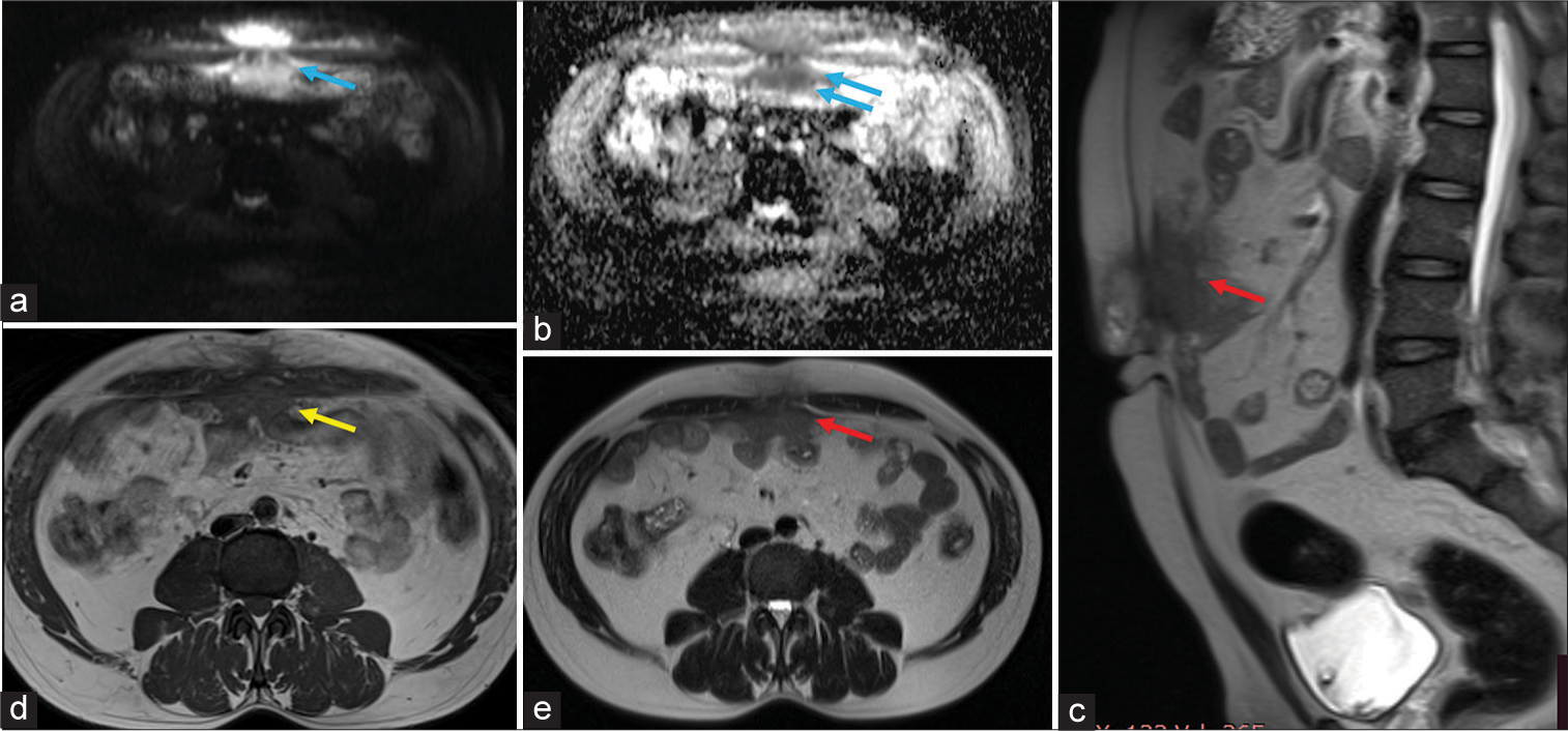 (a and b) Axial DWI and Apparent diffusion coefficient (ADC) show an irregular diffusion-restricting lesion in the mid-line supra-umbilical region (blue arrows). (c) Sagittal T2WI shows a hypointense lesion (red arrow) in the anterior abdominal wall. (d) Axial T1WI reveals a hypointense lesion (yellow arrow) with minimal inflammation in the subcutaneous plane and abutting the intraabdominal bowel loops. (e) Axial T2WI shows mild thickening of the peritoneum in contact with the lesion (red arrow).