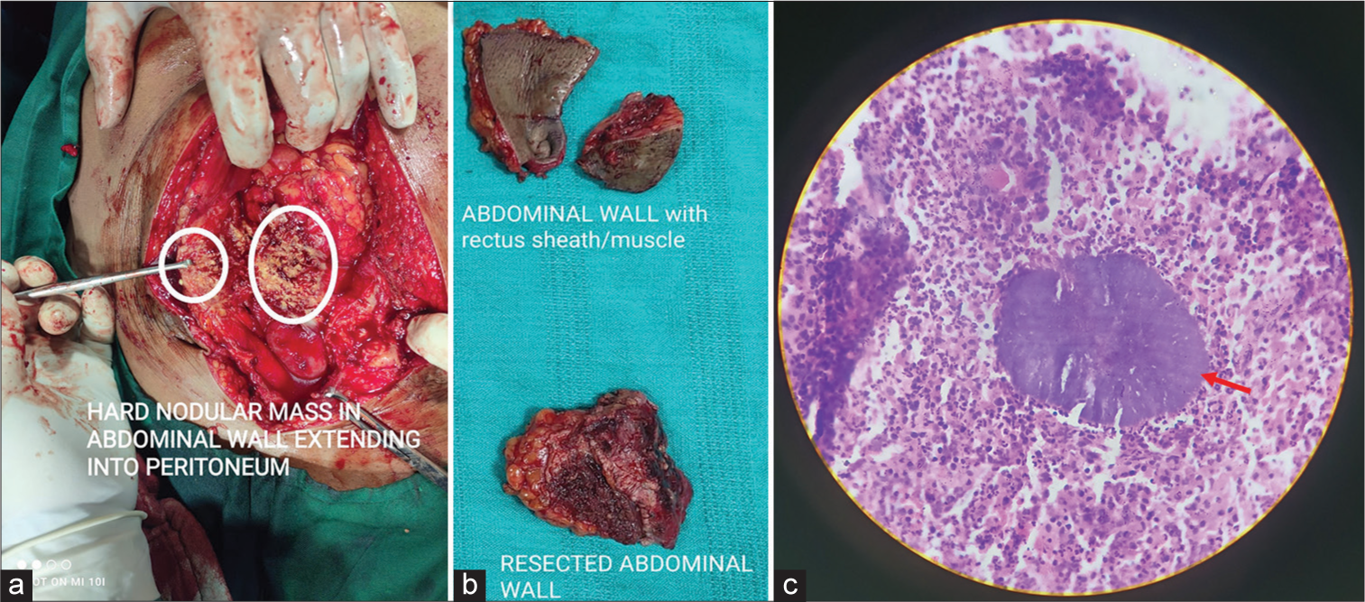 (a and b) Intra operative specimen showing nodular mass (white circles) and surgical specimens. (c) Histopathological examination image showing the actinomycetes colonies with sulphur granules (red arrow).