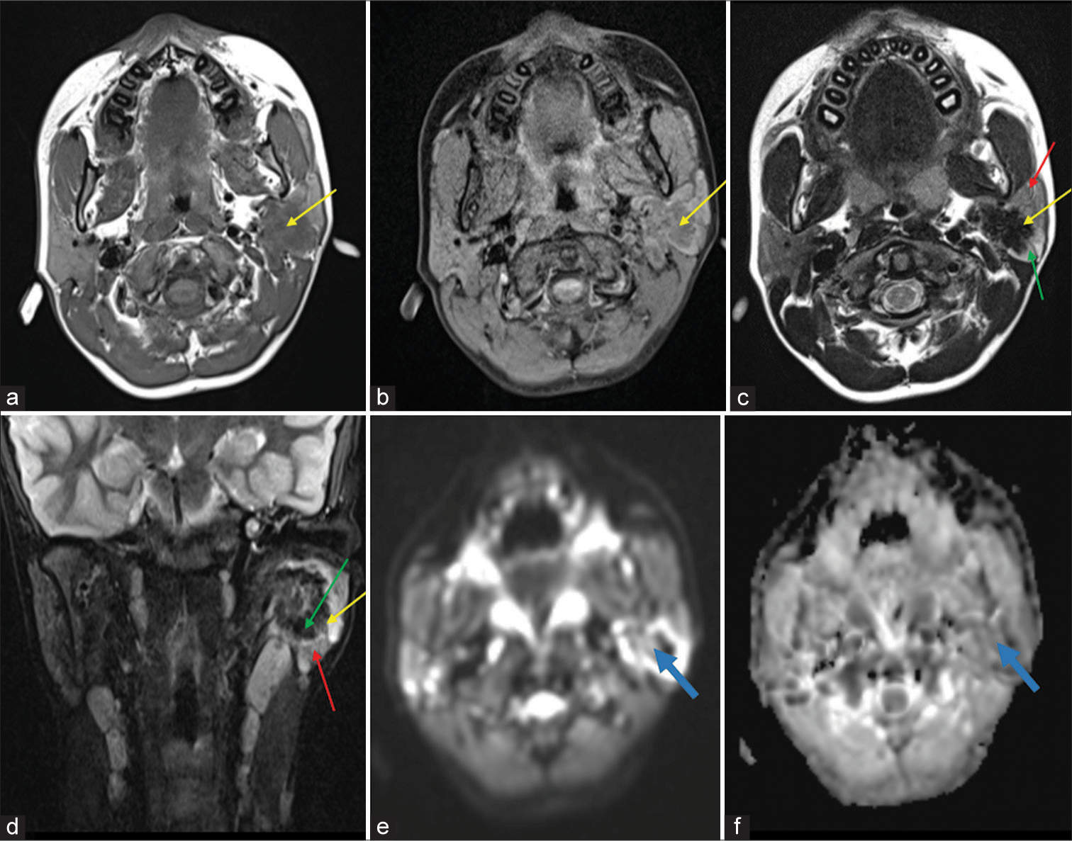 (a) T1 axial image and (b) T1 fat-suppressed axial image showing a relatively well-defined, lobulated hypointense lesion (yellow arrows) in the left parotid gland. (c) Axial T2 and (d) Coronal short-tau inversion recovery images show that the lesion is predominantly hypointense (yellow arrows), with an irregular rim of hyperintensity (green arrows) and the surrounding parotid parenchyma appearing relatively hyperintense (red arrows) on comparison with the contralateral parotid. (e) Diffusion-weighted image and (f) Apparent diffusion coefficient map showing few areas of restricted diffusion in the lesion (blue arrows).