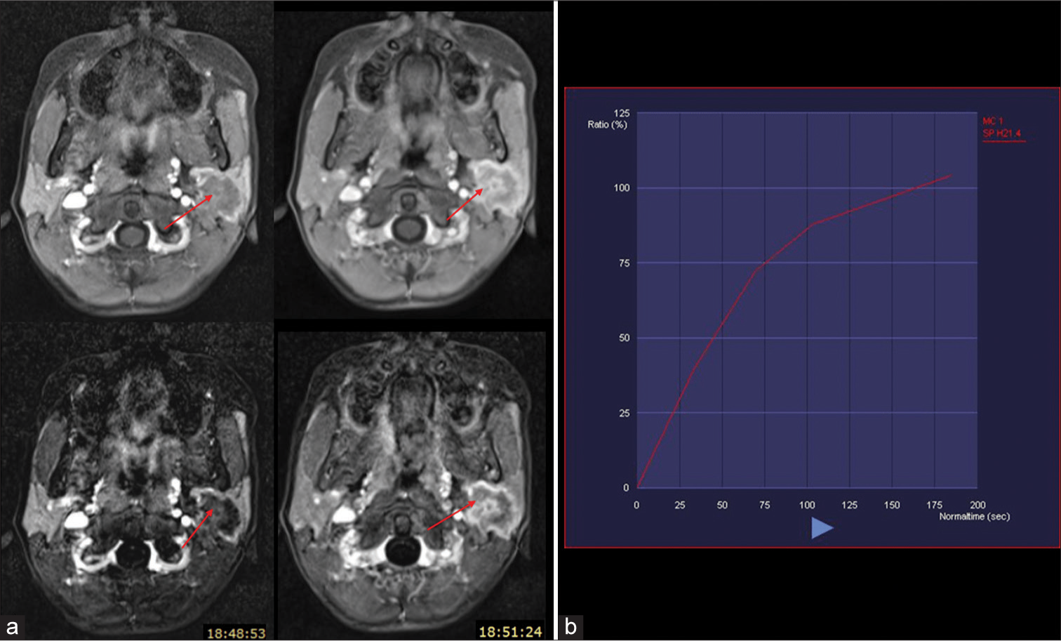 (a) Dynamic contrast-enhanced (above) and subtracted (below) images showing progressive heterogenous enhancement of the lesion (red arrows). (b) Time-signal intensity curve showing gradual enhancement with no washout. Blue arrow signifies increasing time period from contrast administration.