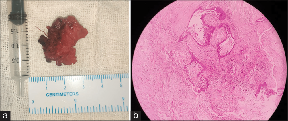 (a) Gross specimen of the excised parotid gland specimen. (b) Histopathological examination shows dense fibrocollagenous stroma surrounding dilated ducts and periductal lymphoplasmacytic infiltrates.