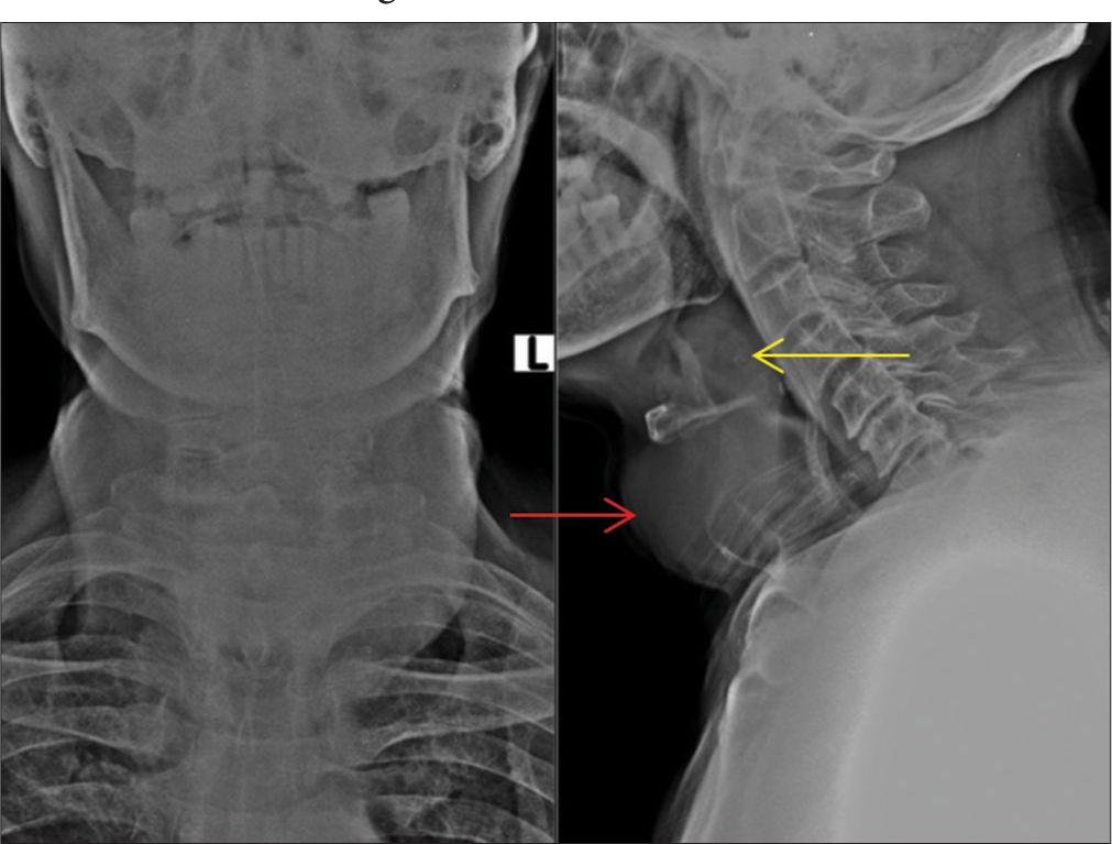 Anteroposterior and lateral radiograph of neck. Lateral radiograph showing diffuse soft-tissue swelling (red arrow) with airway narrowing at the level of hypopharynx and supraglottic larynx (yellow arrow).