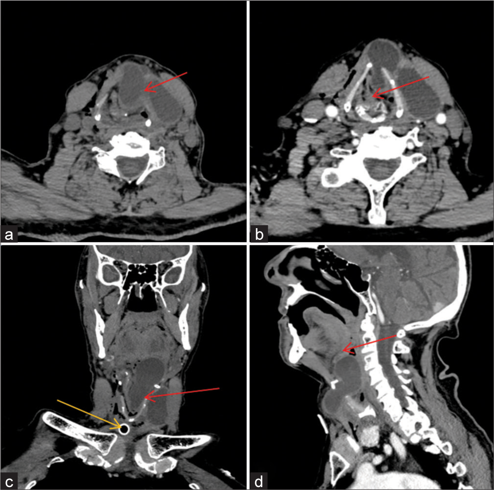 (a) Plain computed tomography (CT) scan of the neck shows a well-defined uniform cystic lesion in the anterior neck underneath the left sternocleidomastoid muscle with a breach in the thyrohyoid membrane at the infrahyoid level and intralaryngeal extension (red arrow). (b) Axial sections of contrast-enhanced CT demonstrated intra-laryngeal extension with compression of the airway column (red arrow). (c) The coronal section of contrast-enhanced CT demonstrated a breach in the thyrohyoid membrane (red arrow) and cranial extension of the cyst into the larynx. The tracheostomy tube (yellow arrow) can be seen in situ with air in the soft-tissue facial planes. (d) The sagittal section of contrast-enhanced CT shows the infrahyoid relation of the thyroglossal cyst with the intra-laryngeal component indenting the base of the tongue (red arrow).