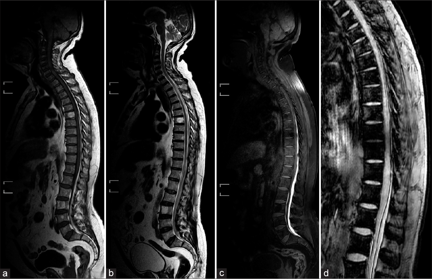T1-weighted (a) and T2-weighted (b) sagittal sections of whole spine show long segment extra-axial hyperintensity extending from D6 to L5 vertebral levels. T1 FAT-SAT (c) sagittal section of whole spine shows no demonstrable signal suppression. T2 gradient (d) sagittal section shows peripheral hypointense hemosiderin rim.