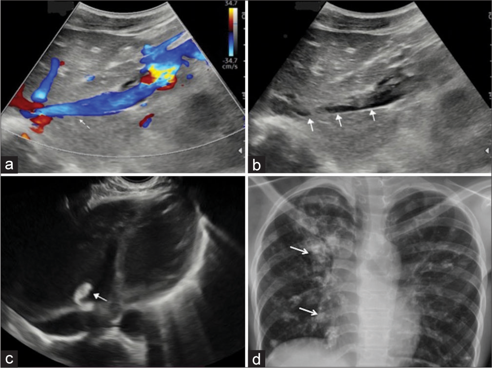 Color Doppler (a and b) mode ultrasound (b) of intrahepatic inferior vena cava shows partially occluding thrombus (solid arrows) with partial color flow (dashed arrow). Transthoracic basal view of cardiac chambers shows a small echogenic thrombus (solid arrow) along the tricuspid valve with clear right ventricle (c). Chest X-ray PA view (d) shows multiple randon ill-defined high-density radio-opaque masses (arrows) with calcification in both lung fields.