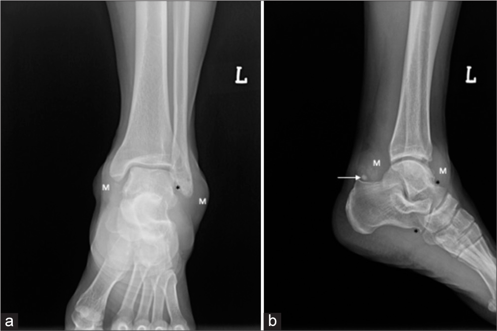 A 28-year-old man with diffuse-type tenosynovial giant cell tumor who presented with progressive left ankle swelling for 2 years. X-ray of the left ankle in the anteroposterior (a) and lateral views (b) showing lobulated periarticular soft-tissue masses (M) with few calcific foci posteromedially (arrow) and extrinsic erosions/scalloping (asterisk) of the dorsal talar neck, plantar aspect of the anterior calcaneum, and distal fibula.