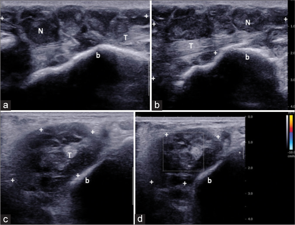 A 28-year-old man with diffuse-type tenosynovial giant cell tumor who presented with progressive left ankle swelling for 2 years. Ultrasonography of the left ankle. Longitudinal (a and b) and transverse (c and d) sonograms along the posteromedial aspect of the ankle (flexor compartment) showing globular heterogeneous mass (cursors “+”) with numerous hypoechoic nodules (N) completely encasing the tendon (T) of flexor hallucis longus and present between the tendon and the underlying bone (b). Color Doppler flow imaging (d) not showing appreciable internal vascularity.
