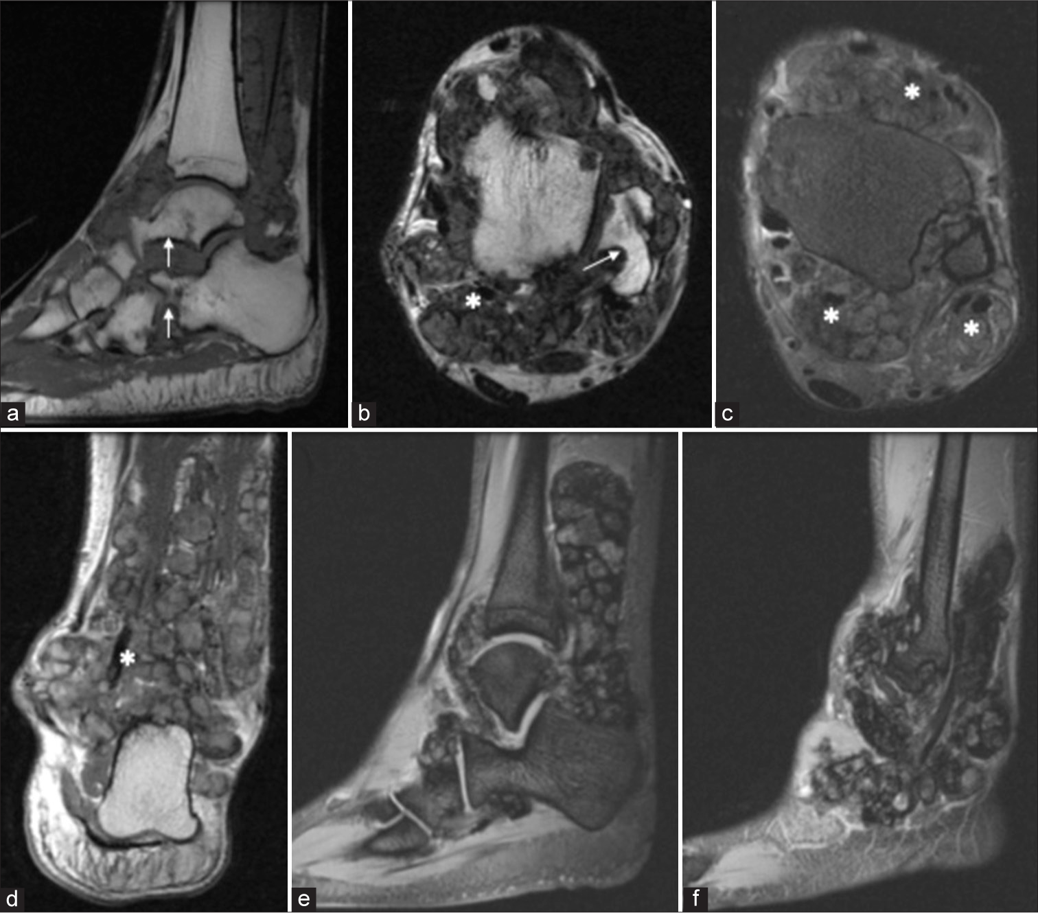 A 28-year-old man with diffuse-type tenosynovial giant cell tumor who presented with progressive left ankle swelling for 2 years. MRI of the left ankle. (a) Sagittal T1-weighted image, (b) Axial T2-weighted image, axial and coronal proton density (PD)-weighted image (c and d) showing an extensive globular mass like synovial proliferation with multiple T1 isointense and T2/PD hypointense nodules along the bursae, recesses, and tendon sheaths causing extrinsic pressure erosions of multiple bones (white arrow) and encasing multiple tendons (asterisk). Gradient recalled echo images (e and f) showing characteristic “blooming artifact” confirming the presence of hemosiderin deposition.